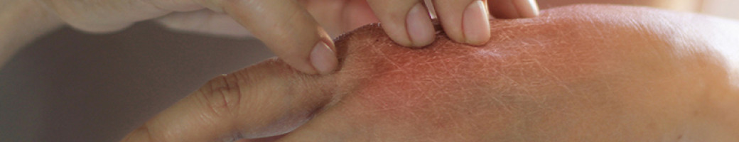 Έκζεμα Έκζεμα