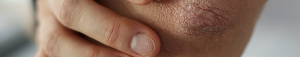 Ψωρίαση Ψωρίαση