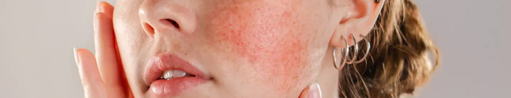 Κοκκινίλες Κοκκινίλες